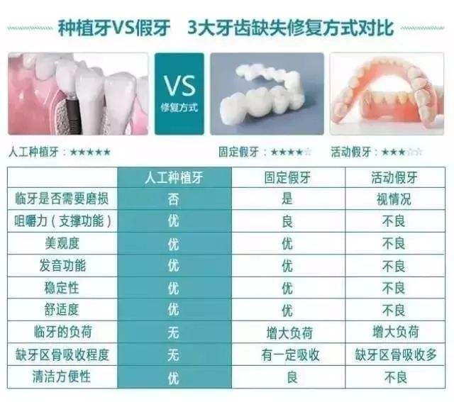 北京劲松口腔医院科普种植牙