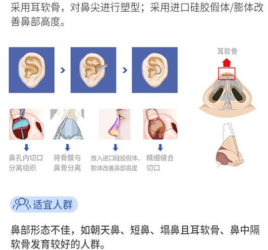 南宁华美整形医院科普隆鼻手术知识