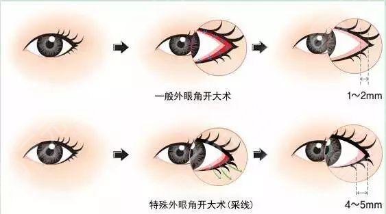 开内眼角手术效果好吗?