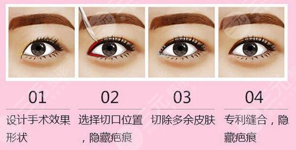 开内眼角手术后的注意事项