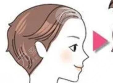 西安艺星植发案例分享