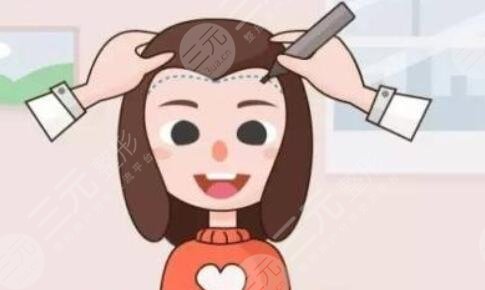 温州大麦微针植发医院发际线改善案例介绍