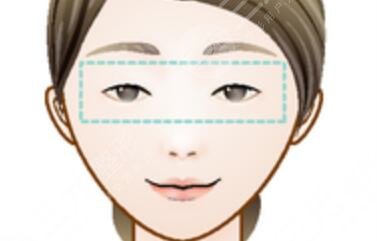 赫本美容院全切双眼皮案例