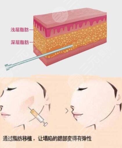 深圳维多利亚门诊部面部填充案例