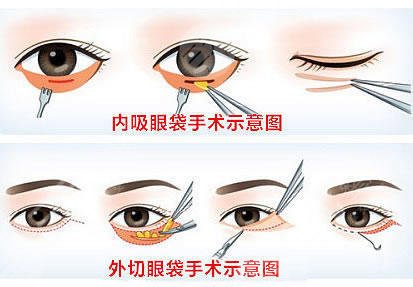 做眼袋