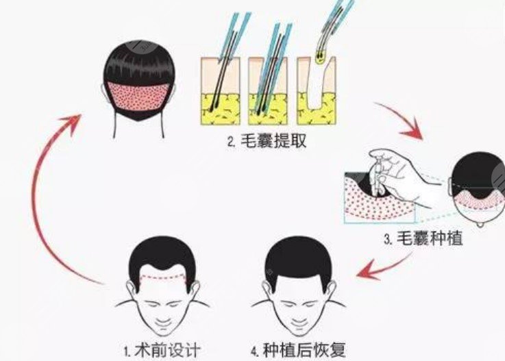 南方医科大学南方医院鬓角种植相关问答