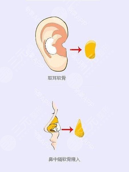 　濮阳时光医疗美容诊所隆鼻科普