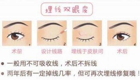 南京华美美容医院科普双眼皮手术知识