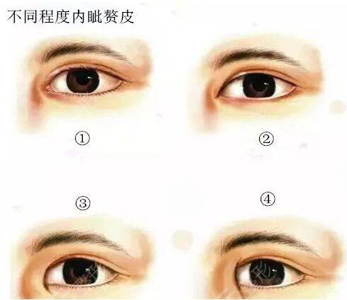 做开眼角手术之后