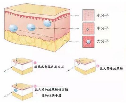 隆鼻