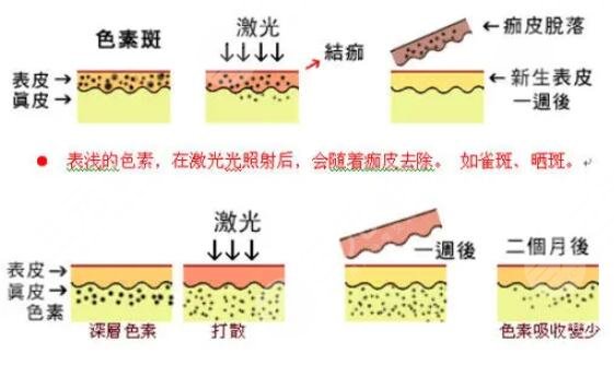 祛斑