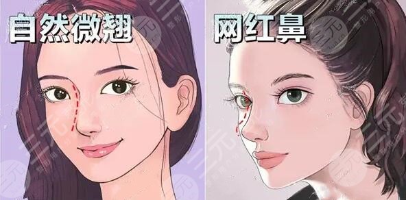 宁波艺星整形医院鼻整形案例