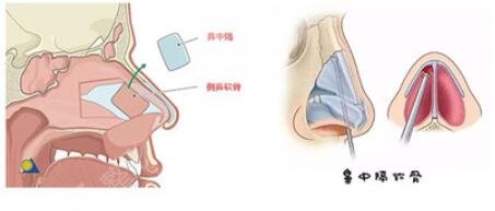 恩喜整形医院案隆鼻案例