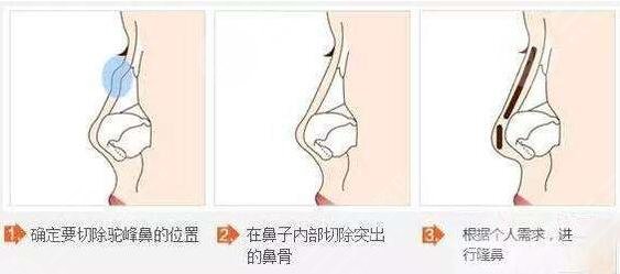 隆鼻手术