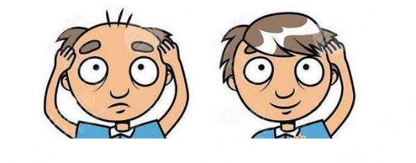 深圳北大医院植发中心植发案例分享