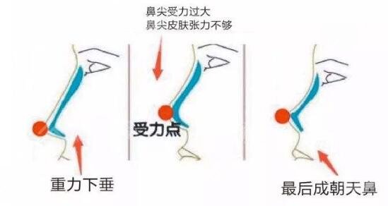 硅胶隆鼻