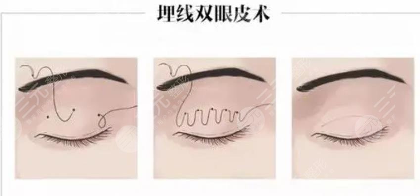 广州南方医院双眼皮埋线案例