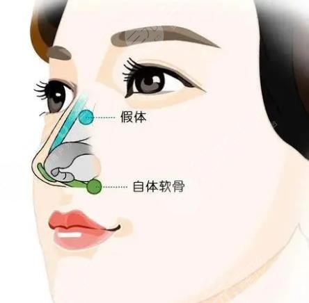 哈医大二院整形科隆鼻整形案例