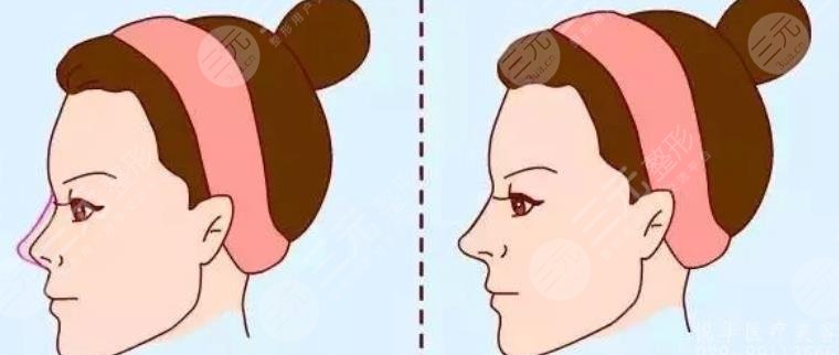 做鼻部整形手术有坏处吗?