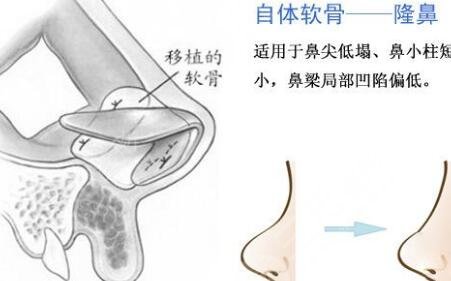 假体隆鼻之后需要多久恢复?