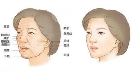 脂肪填充效果