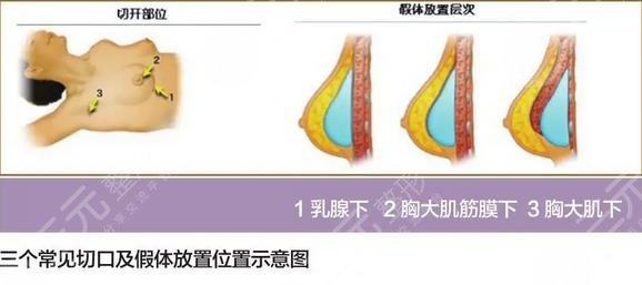 隆胸的过程