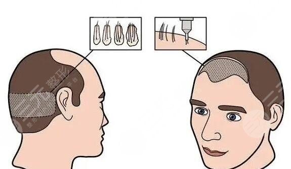 上海植发案例反馈