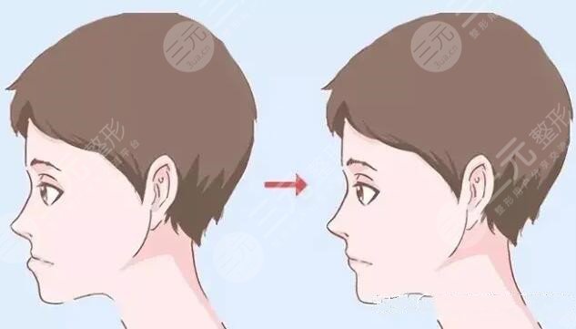 中山一院正颌手术案例