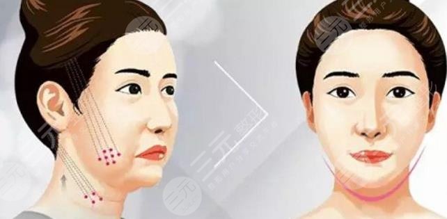 面部提升