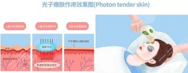 光子嫩肤原理