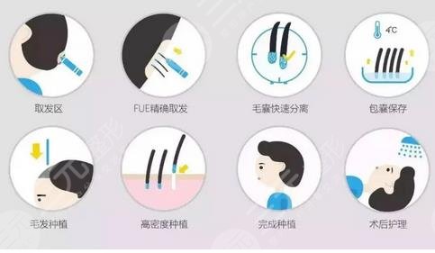 植发过程