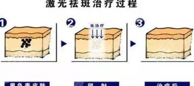 祛斑