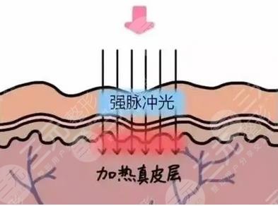 烧伤修复