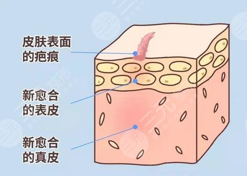 去疤痕