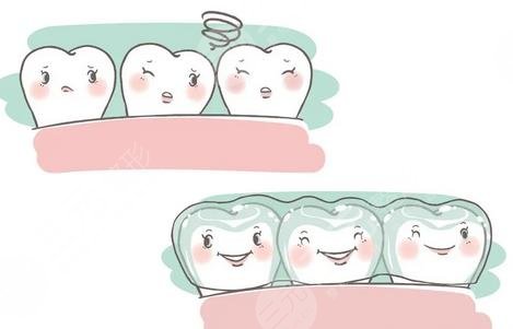隐形牙套