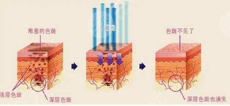 激光治疗