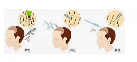 植发原理
