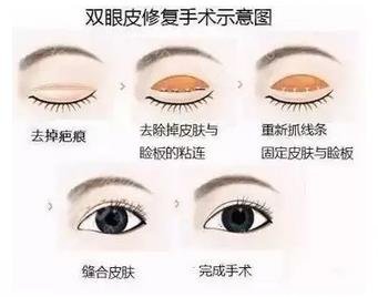 双眼皮手术