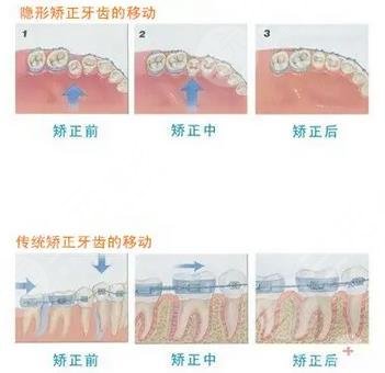 牙齿矫正步骤