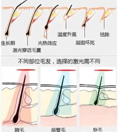 激光脱毛