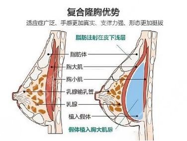 乳房塑造