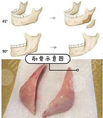 磨骨过程
