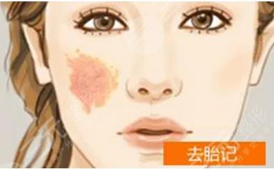 祛胎记