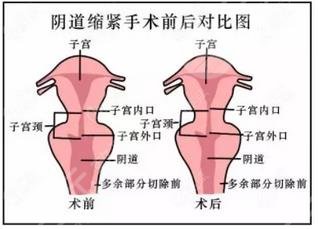 阴道手术