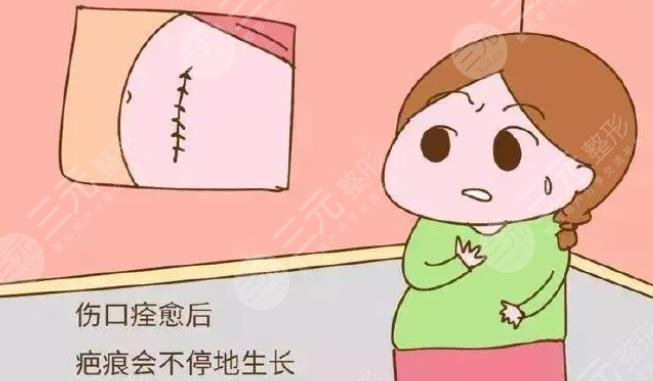 疤痕修复剖腹产