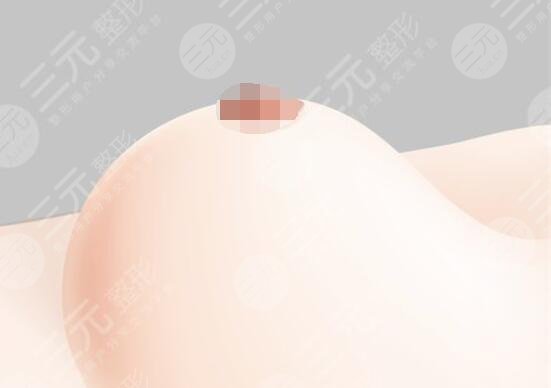 玻尿酸隆胸