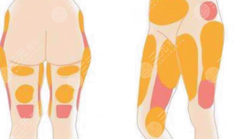 吸脂瘦大腿