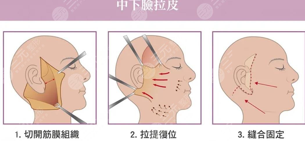 45岁适合做小拉皮还是大拉皮