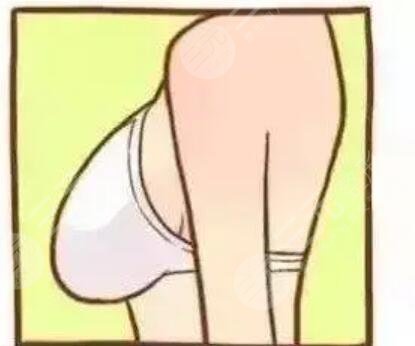 整形美容外科隆胸果图