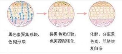 天鹅湖整形医院祛斑多少钱?